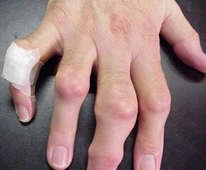 jari dengan kecacatan sendi menyebabkan sakit