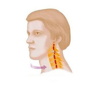 sindrom vertebral dengan osteochondrosis serviks