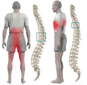sakit belakang dalam osteochondrosis toraks