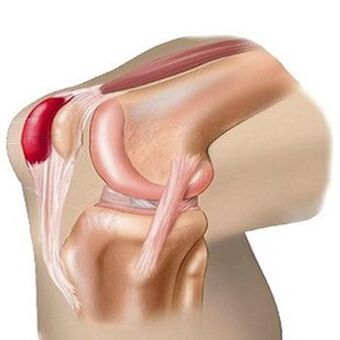 Salah satu punca kesakitan pada sendi lutut ialah bursitis. 