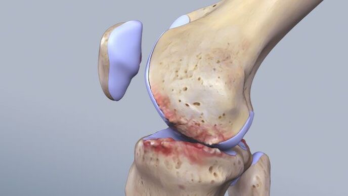Struktur sendi lutut terjejas oleh patologi