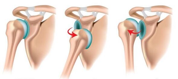 Dislokasi anterior dan posterior sendi bahu, memprovokasi perkembangan arthrosis