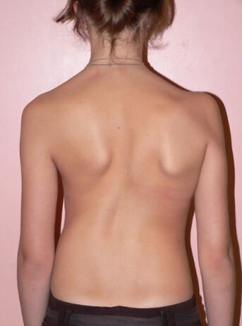 Scoliosis 2 darjah