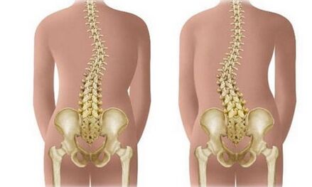 Scoliosis bukan presistant