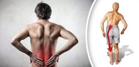 Sindrom Sakit dengan osteochondrosis lumbar memancarkan kaki