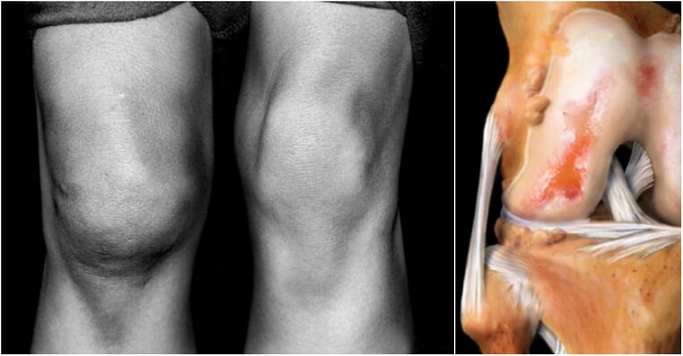 Arthrosis sendi lutut dan sakit sendi