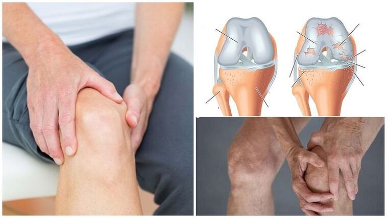 Gejala sakit lutut arthrosis sendi lutut