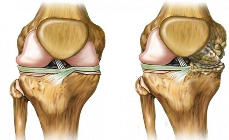 Sihat dan terjejas oleh sendi arthrosis