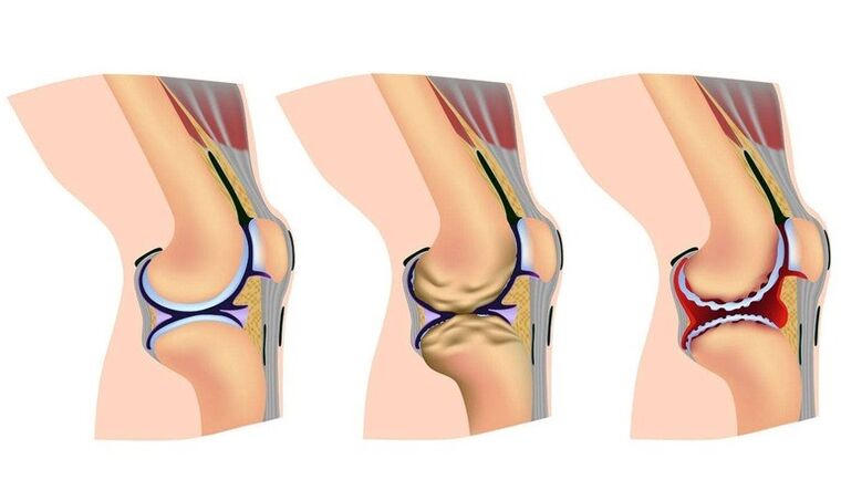 Tahap ubah bentuk pada sendi lutut untuk arthrosis