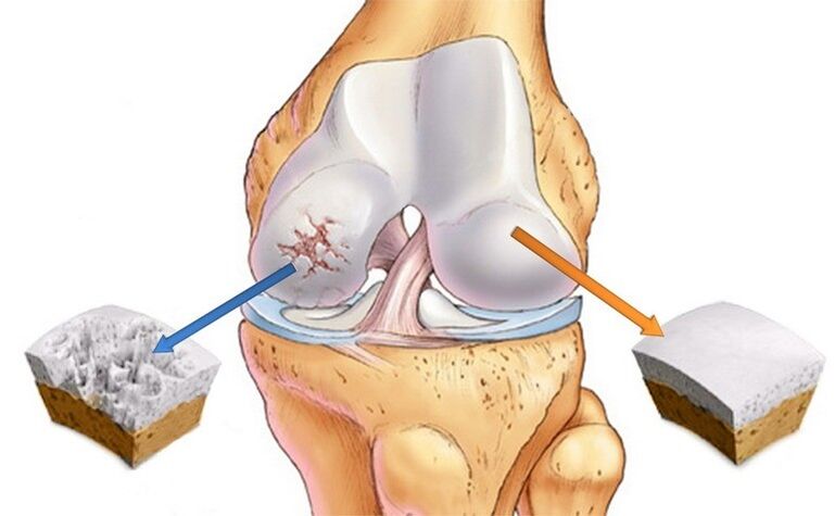 rawan biasa dan terjejas oleh arthrosis