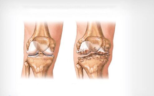 arthrosis sendi lutut