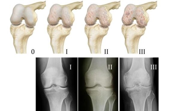 kaedah untuk mendiagnosis arthrosis lutut