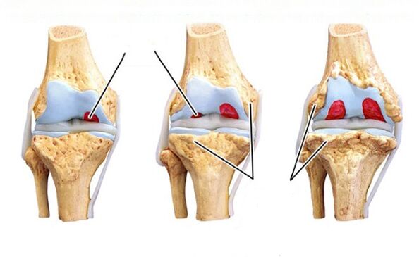 peringkat arthrosis lutut